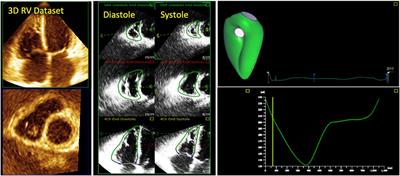 Added value of 3D echocardiography in the diagnosis and prognostication of patients with right ventricular dysfunction